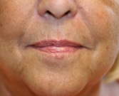 Feel Beautiful - Smile Lines Treatment (filler) - Before Photo